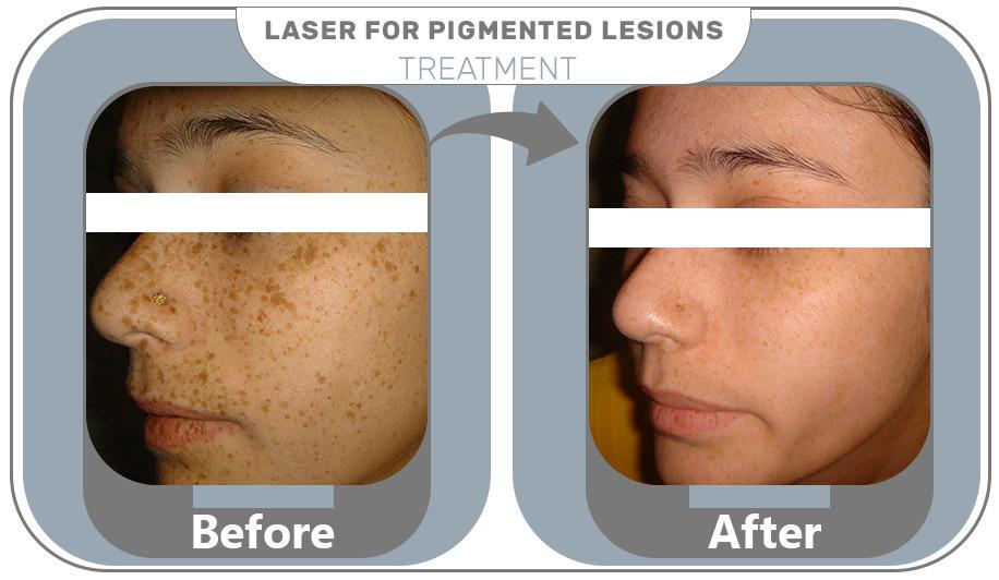 Skin Pigmentation Treatment 1