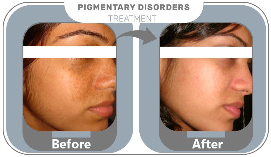 Skin Pigmentation Treatment