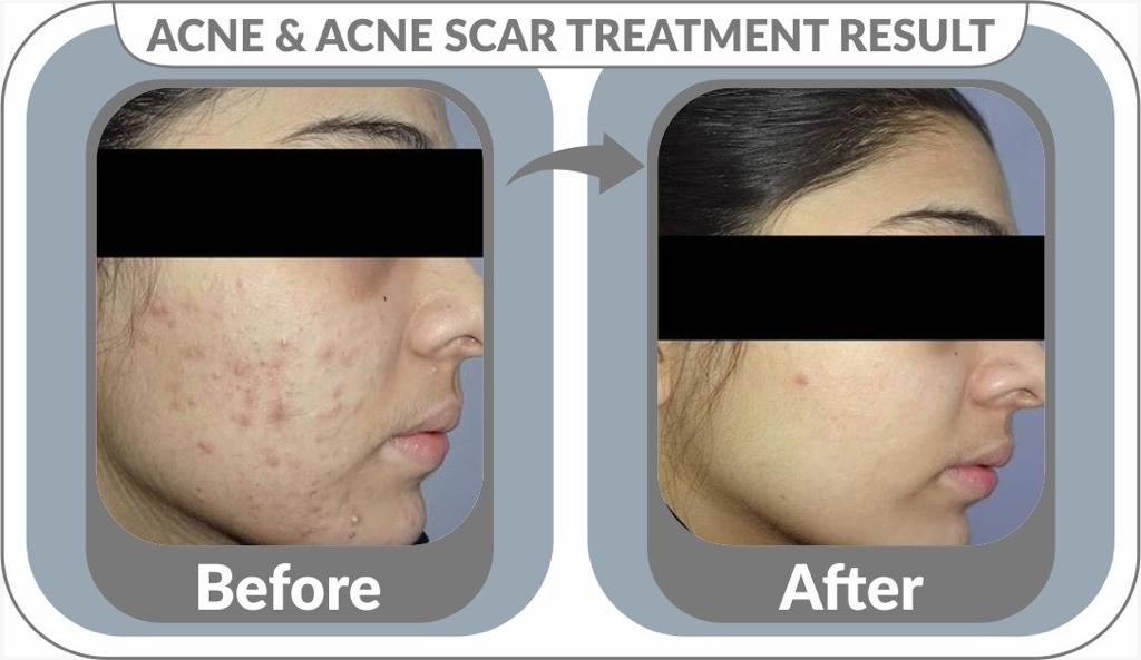 Acne Scar Treatment Gallery
