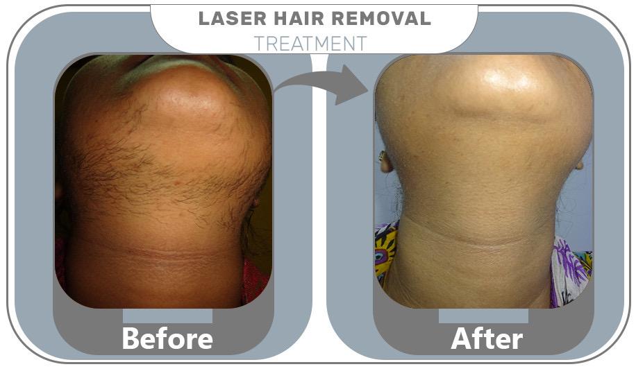 Laser Hair Removal Gallery
