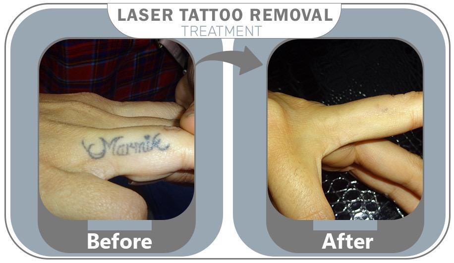 Permanent Tattoo Removal