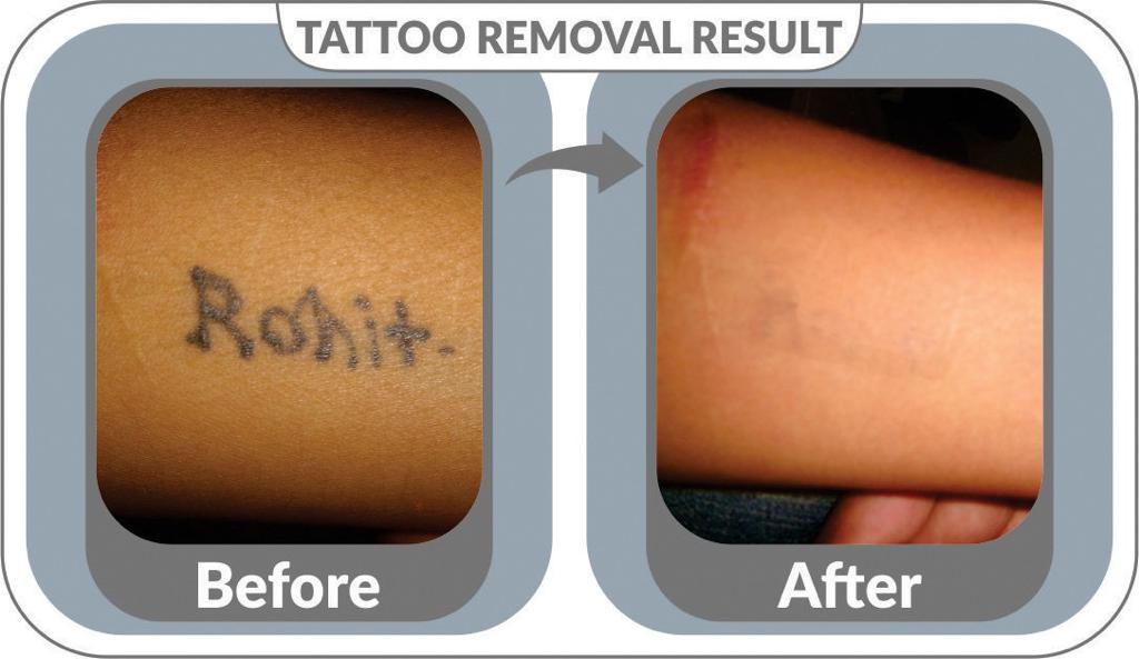 Permanent Tattoo Removal Gallery