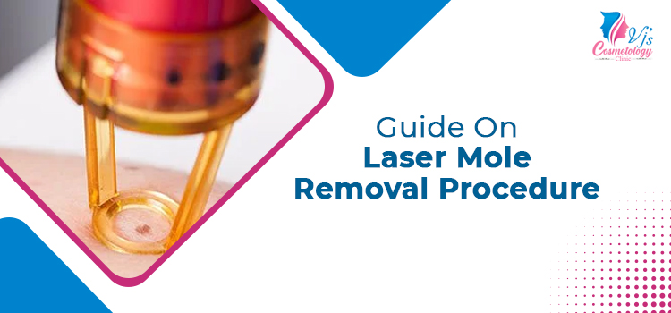 Guide On Laser Mole Removal Procedure