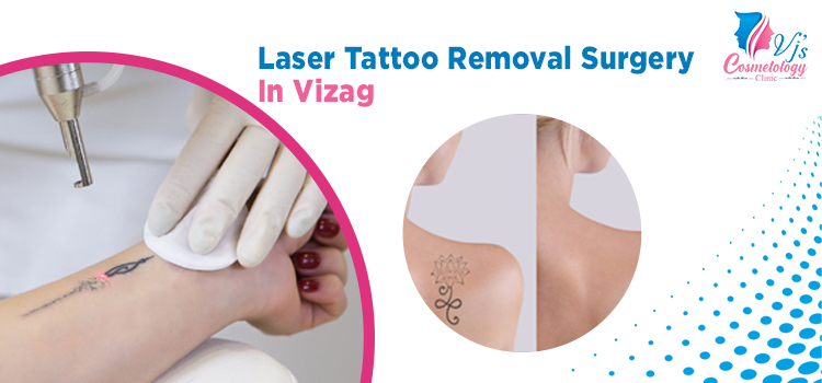Laser Tattoo Removal Surgery In Vizag