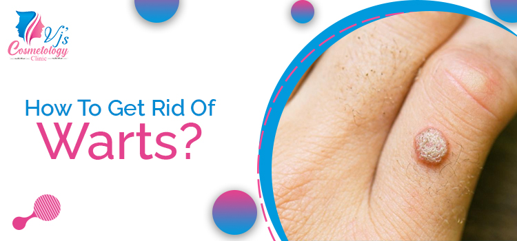 How To Get Rid Of Warts?