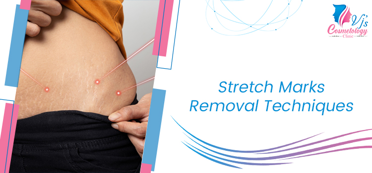 Stretch Marks Removal Techniques