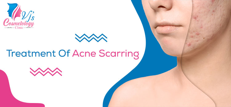 Treatment-Of-Acne-Scarring