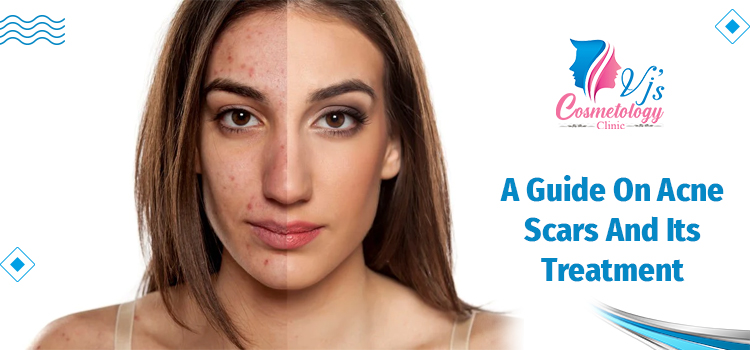  What Are Acne Scars, Its Different Types, And Its Removal Treatment?