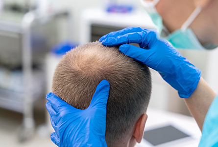  Are the results of hair transplantation permanent? Do these get affected with age?